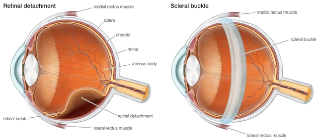 The Relationship between Ocular Hypertension and Retinal Detachment