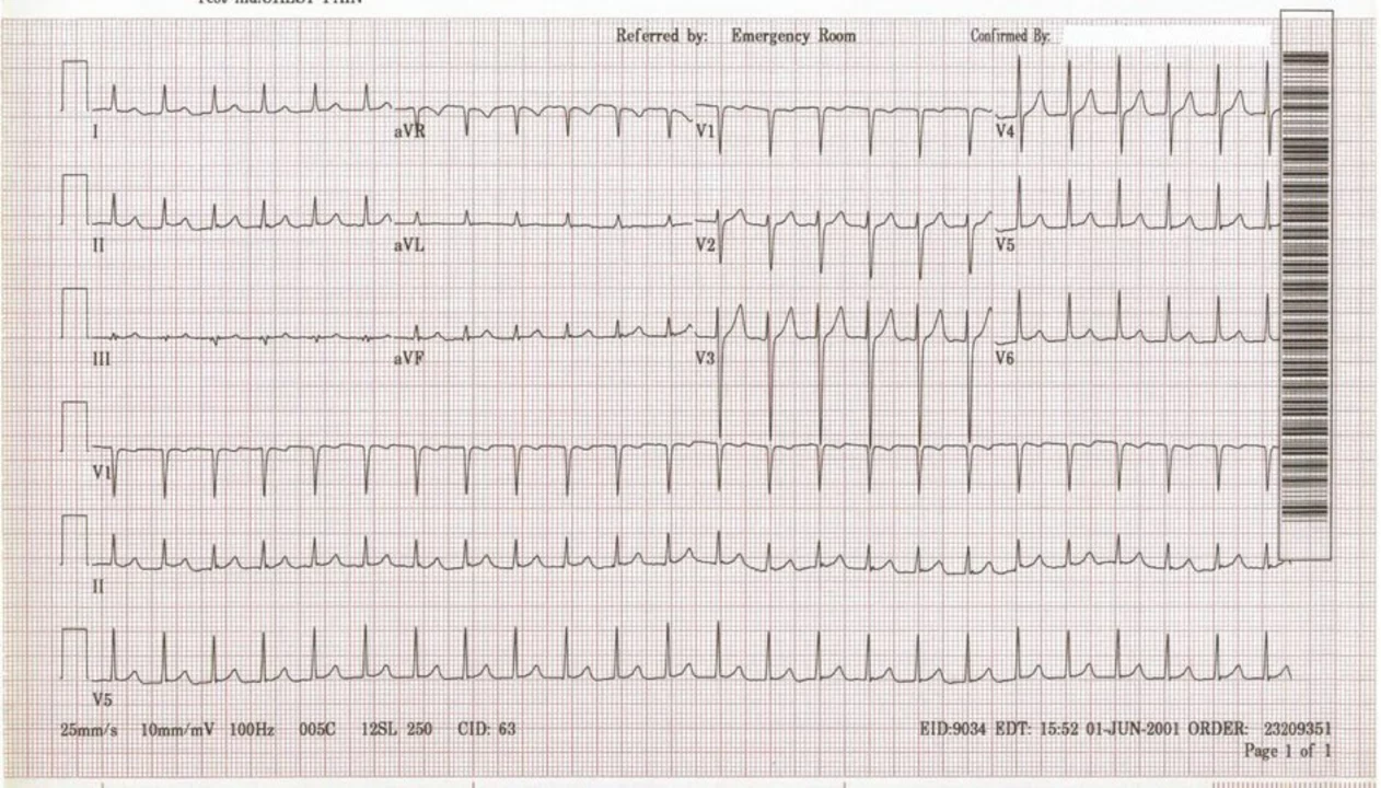 The Importance of Regular Check-ups for Supraventricular Tachycardia Patients